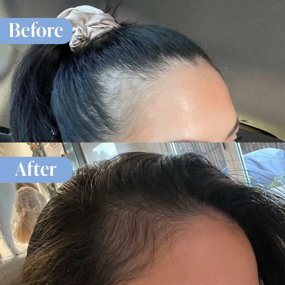 Anti-Hair Loss Treatment Bundle