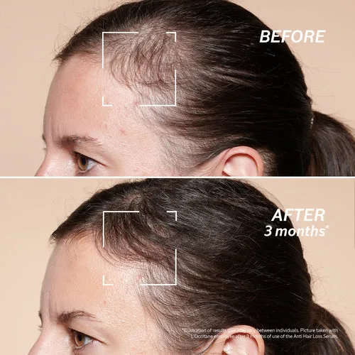 Anti-Hair Loss Treatment