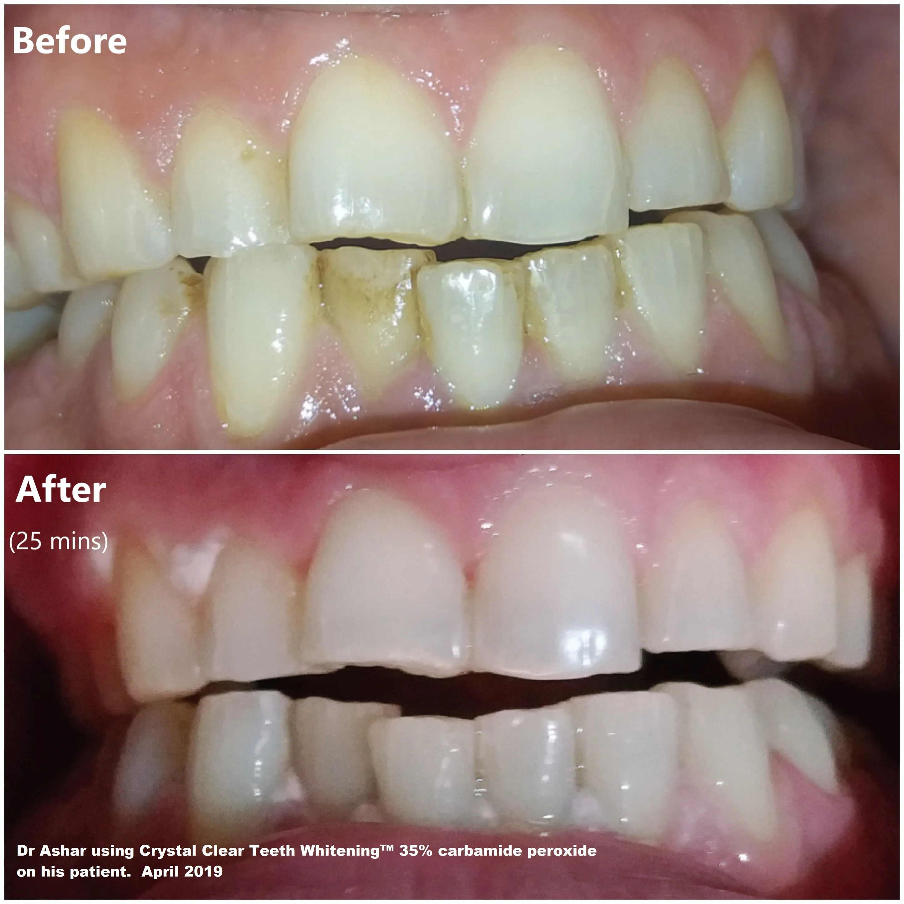 Crystal Clear Teeth Whitening At-Home Teeth Whitening All-in-One Kit