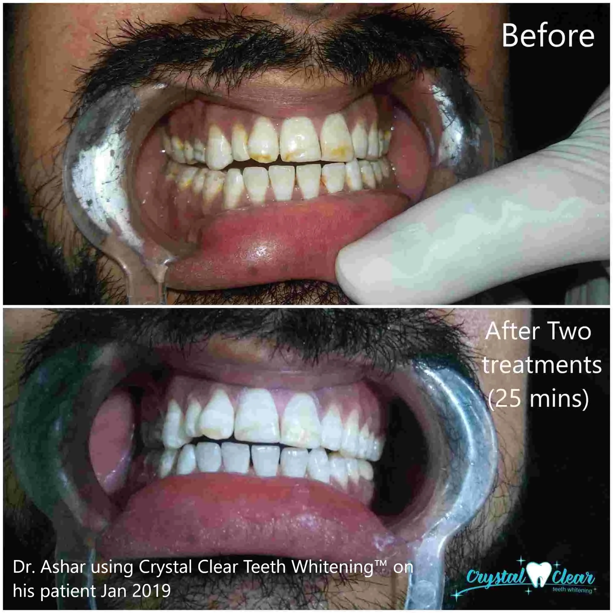 Crystal Clear Teeth Whitening At-Home Teeth Whitening All-in-One Kit
