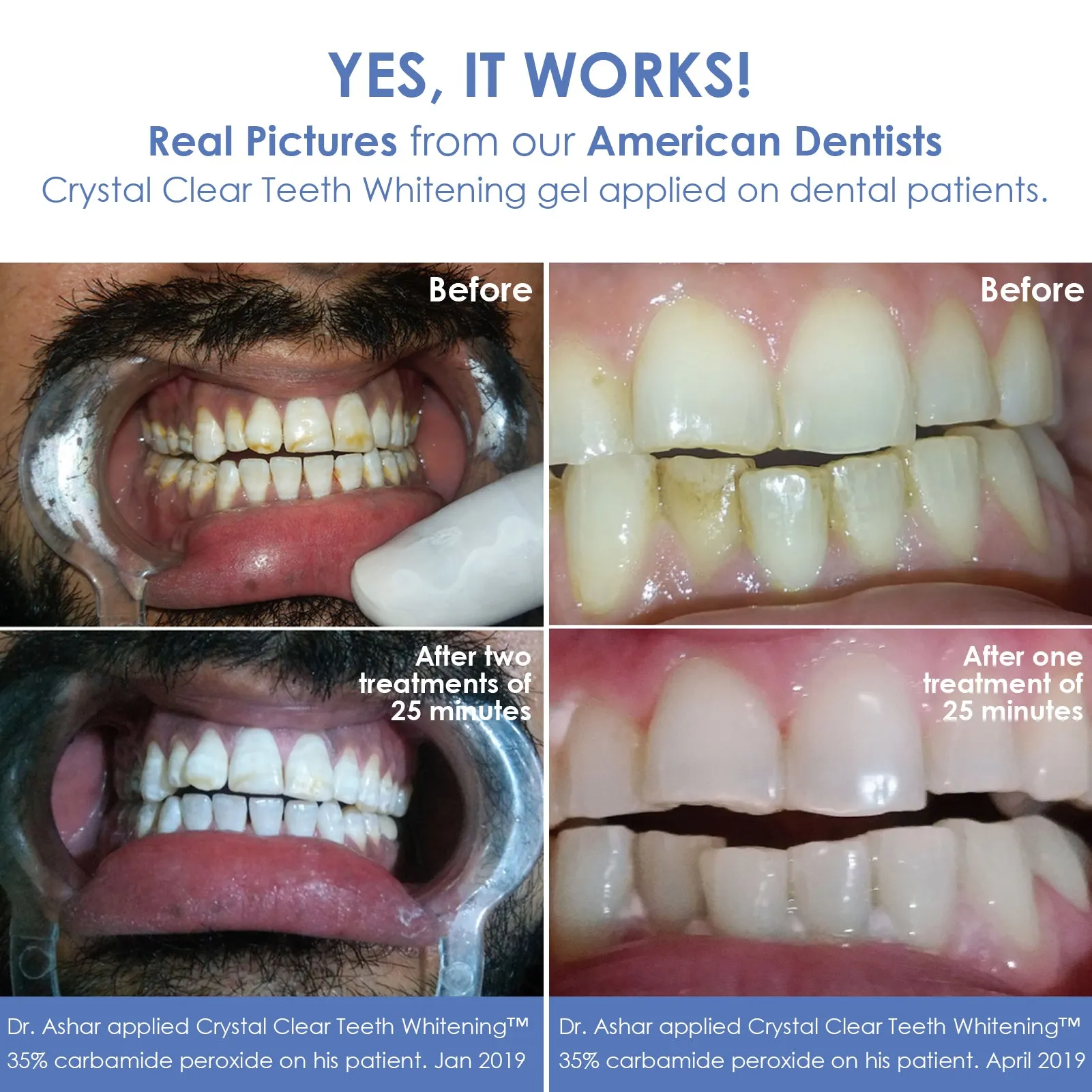 Crystal Clear Teeth Whitening At-Home Teeth Whitening All-in-One Kit