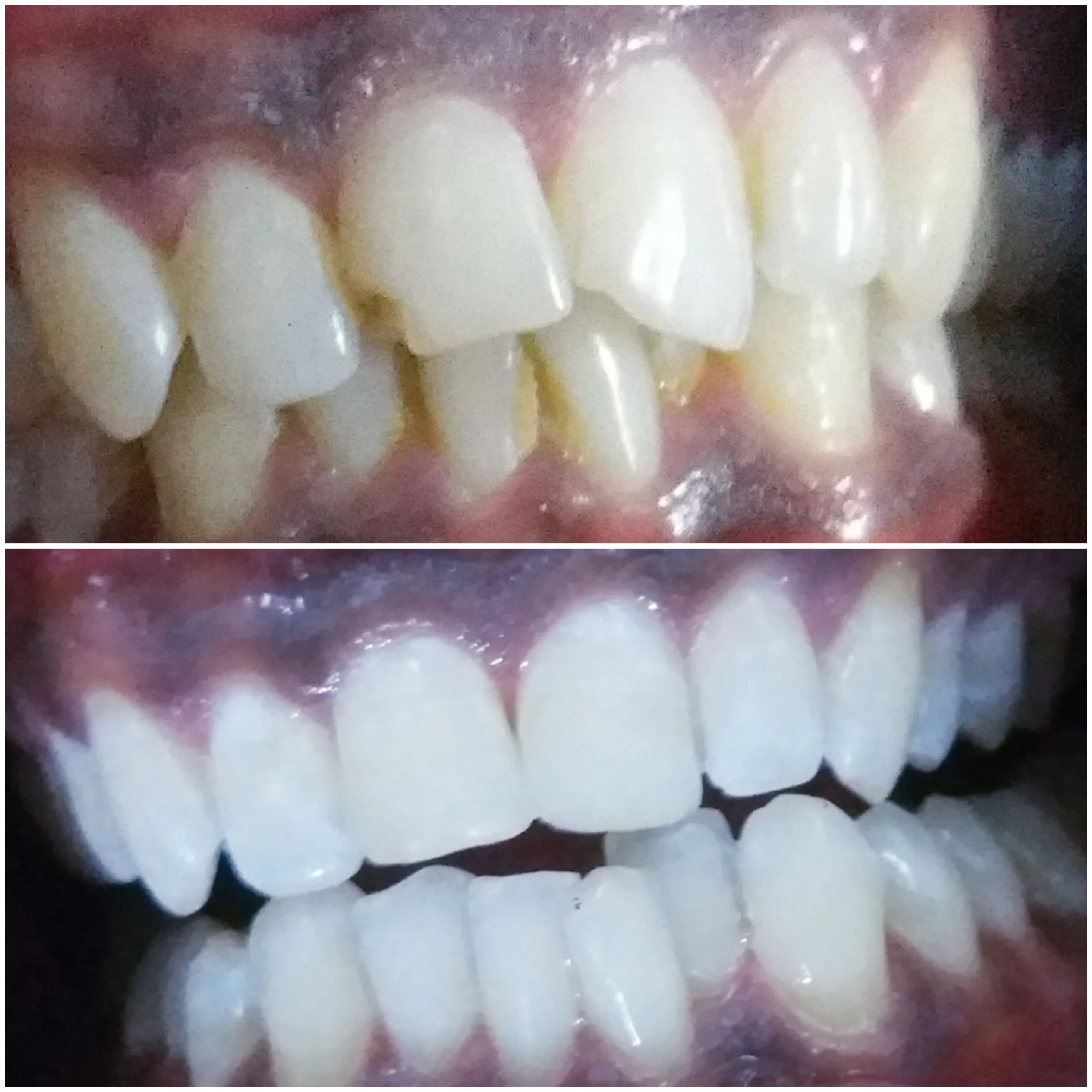 Crystal Clear Teeth Whitening At-Home Teeth Whitening All-in-One Kit