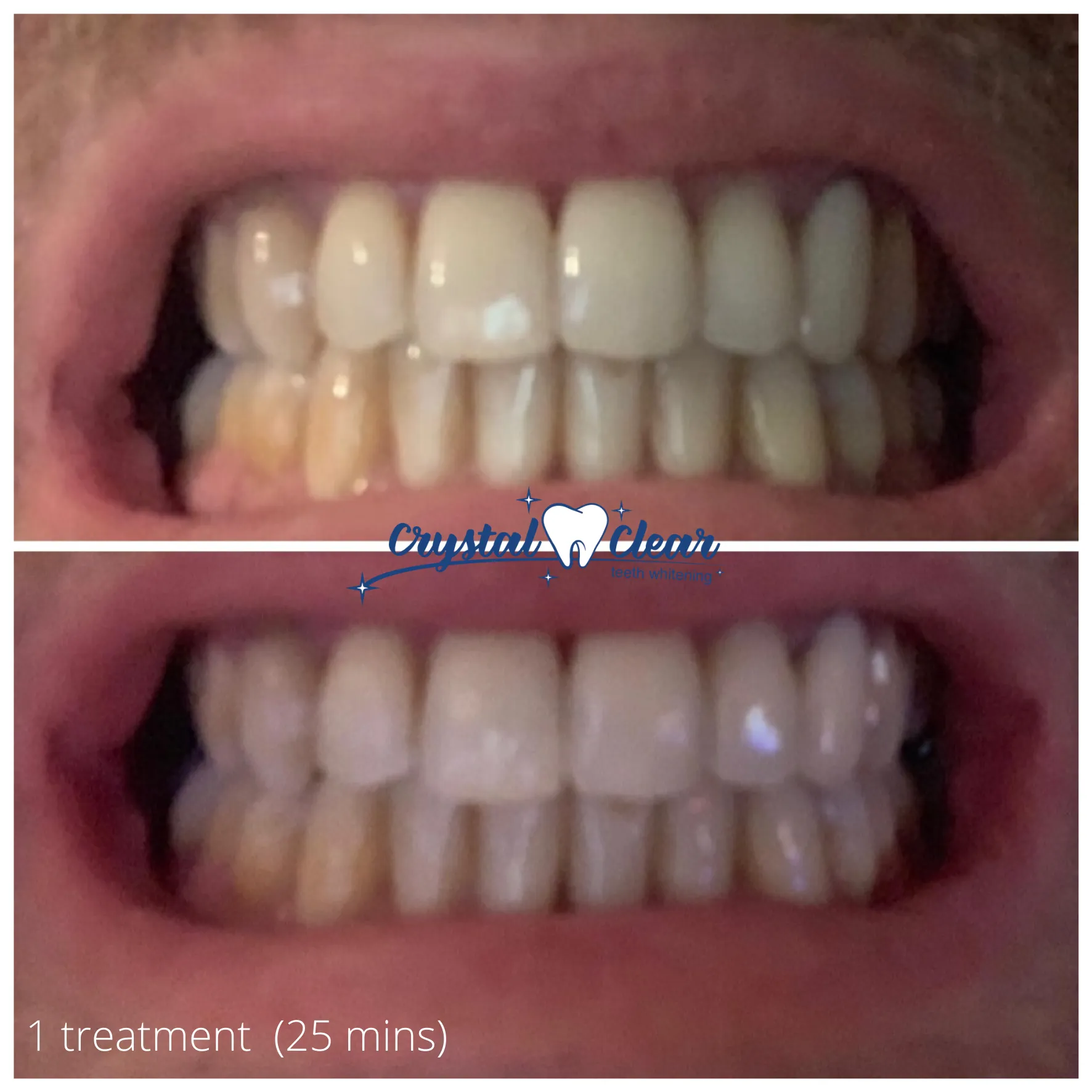 Crystal Clear Teeth Whitening At-Home Teeth Whitening All-in-One Kit