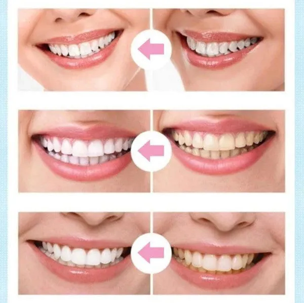 Dental Whitening Pen