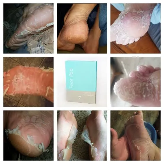 Foot Peel