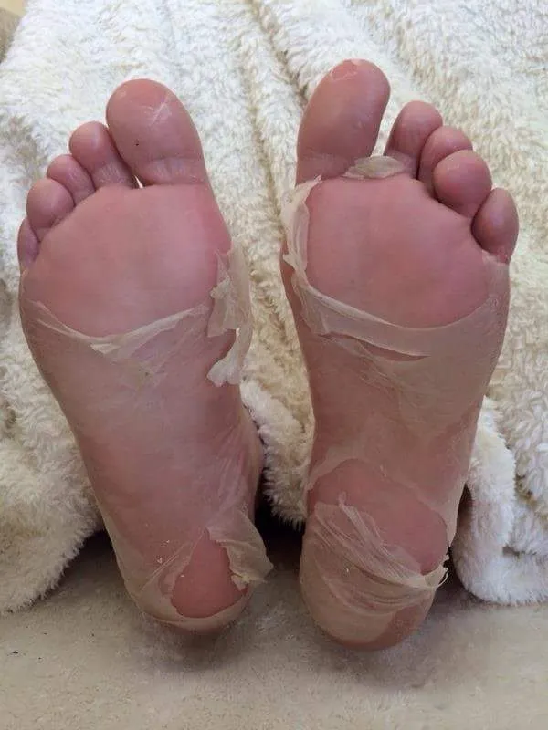 Foot Peel