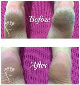 Foot Peel