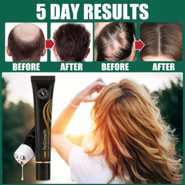 Ginger Hair Loss Treatment