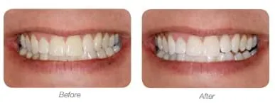 LumiSmile White Take-Home Teeth Whitening Treatment Syringes; Two (2) 2.5 ml Syringes of 16% Carbamide Peroxide Whitening Treatment