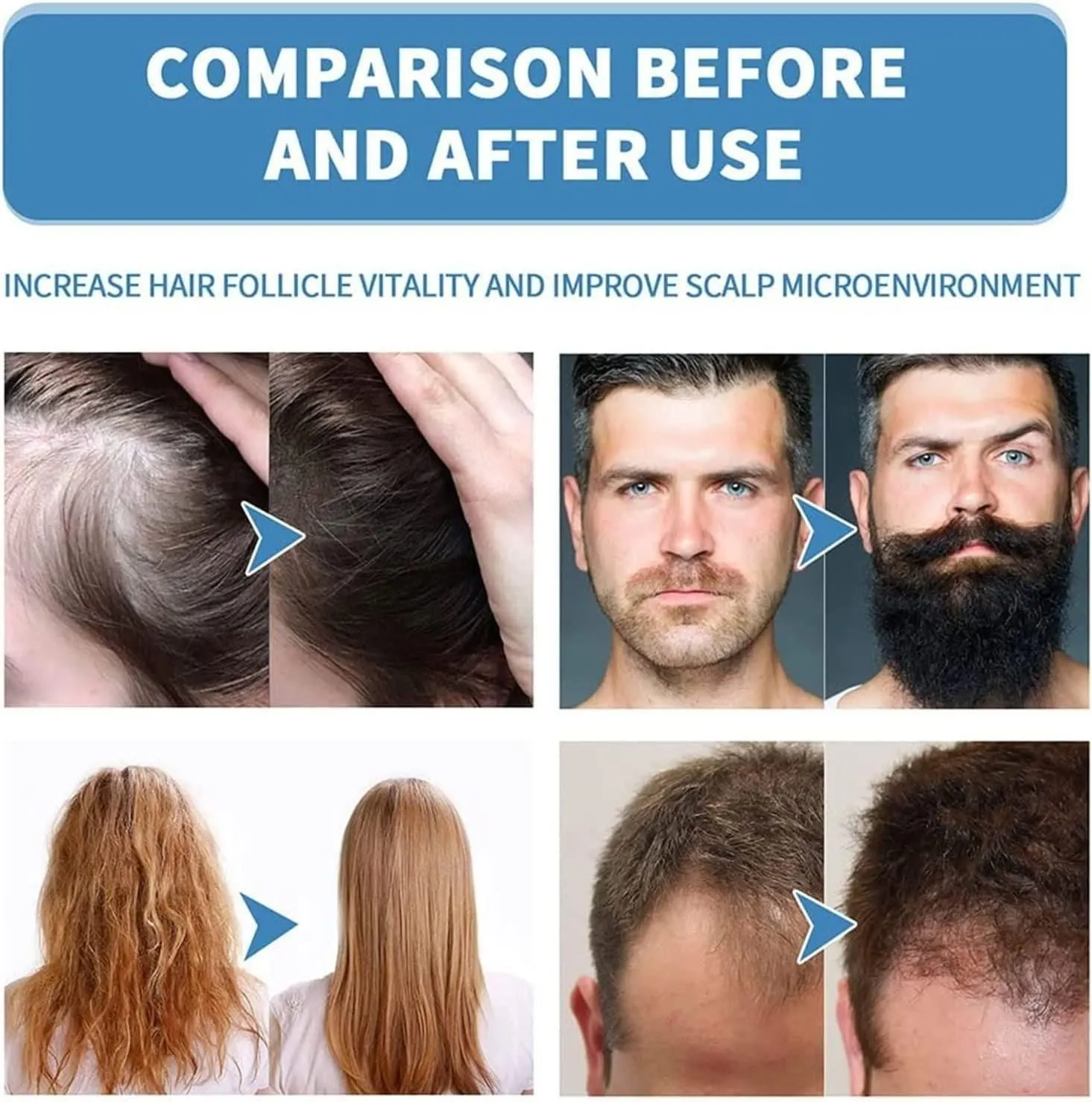 Minoxi Roll-On Hair Treatment Hair Growth Serum (Buy 1 Get 1 Free)