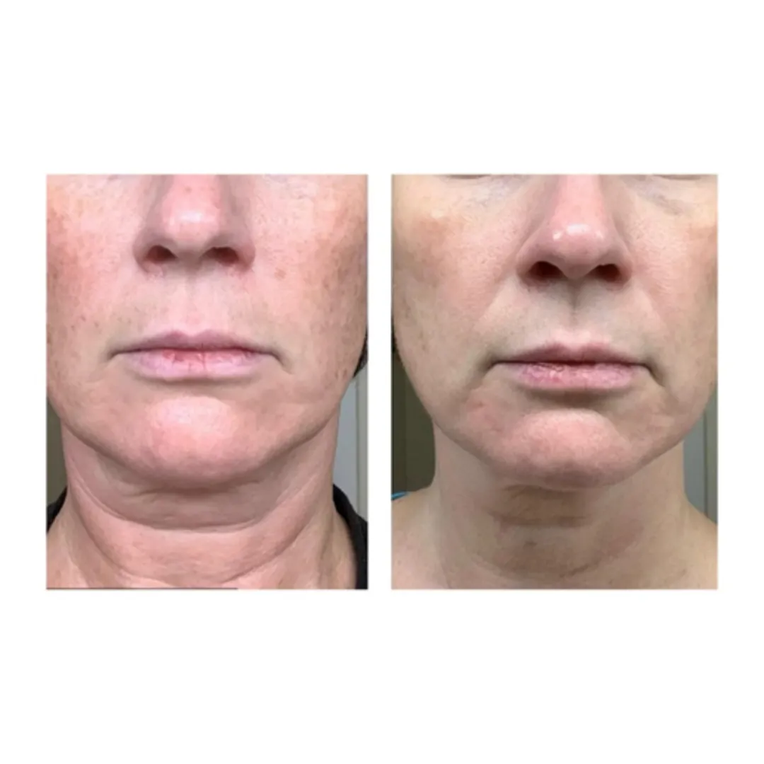 NECK FIRMING CREAM