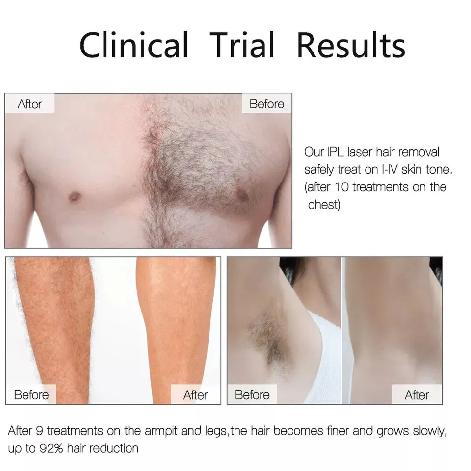 Painless Laser Hair Removal Device