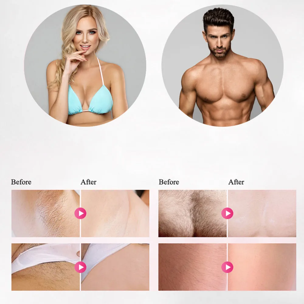 Permanent IPL Laser Hair Removal