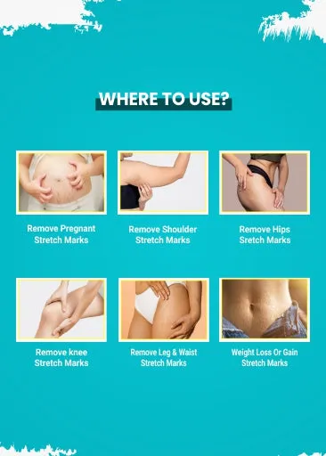 Stretch Mark Removal Cream