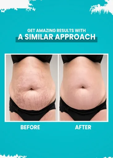 Stretch Mark Removal Cream
