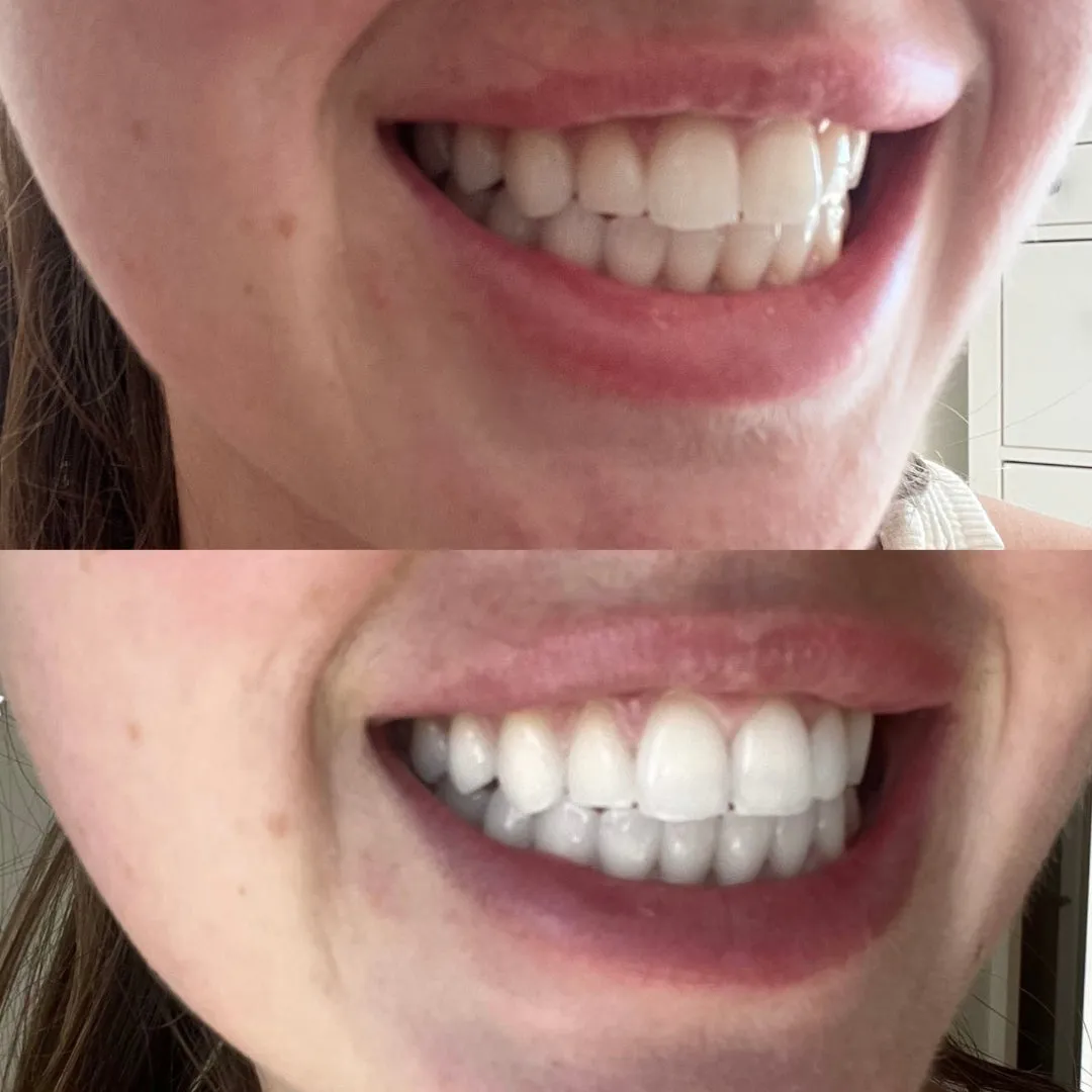 Teeth Whitening Gel