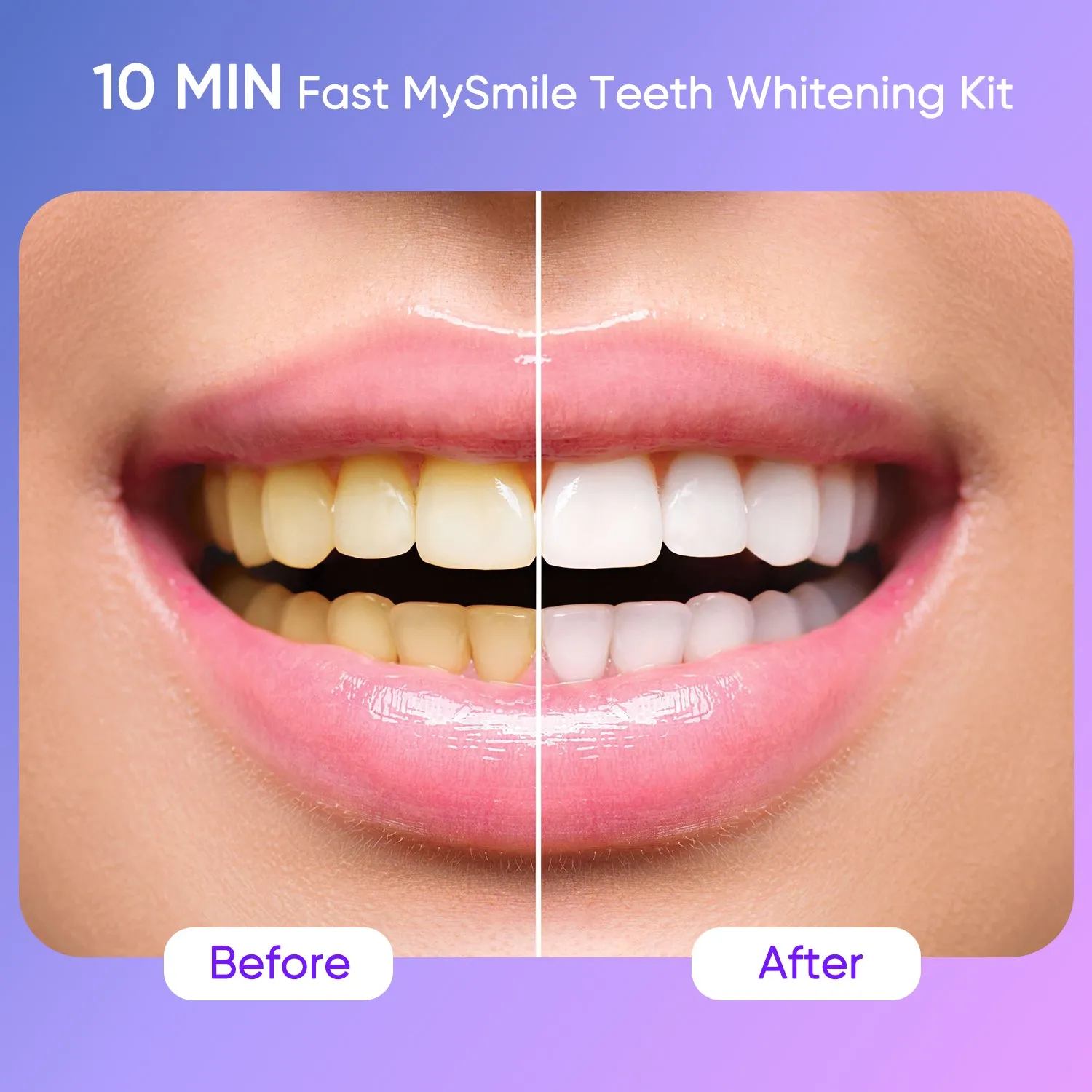 Ultimate Teeth Whitening Kit with Refills Bundle
